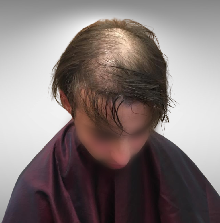 Men’s Hair Replacement at Hair Center International